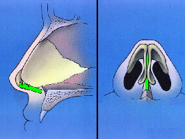 Rhinoplasty - Nose correction surgery - Dr Murali Mahadevan - ENT Surgeon